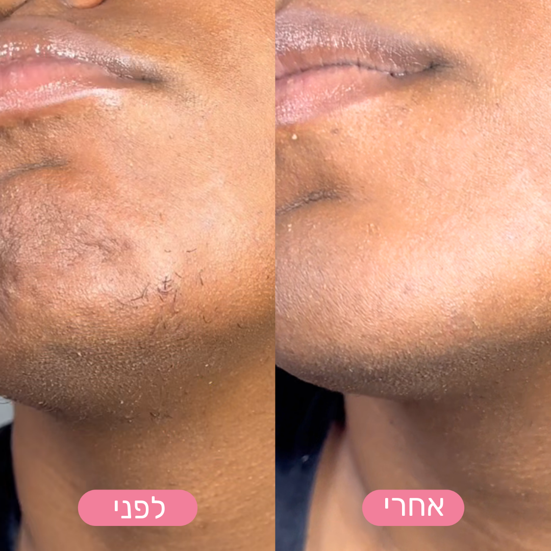 MiGlow - הסרת שיער פנים עדינה ובטוחה לעור רגיש