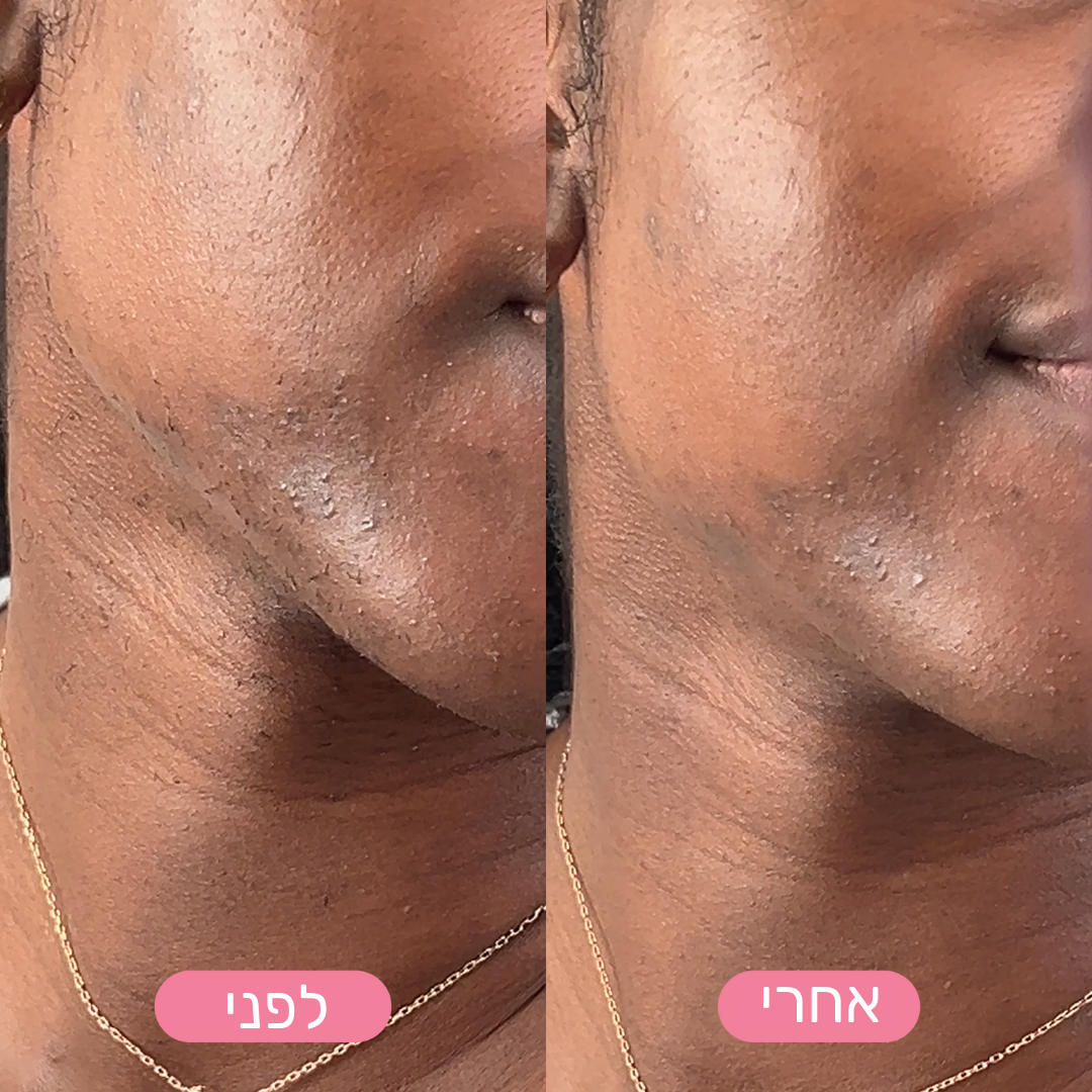 MiGlow - הסרת שיער פנים עדינה ובטוחה לעור רגיש